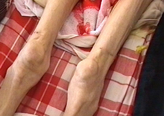 王霞被呼和浩特市女子监狱迫害得瘦骨嶙峋，奄奄一息。（2004年7月）