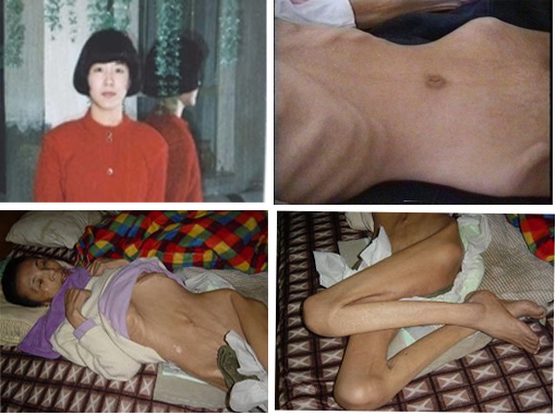 上部：内蒙古巴彦法轮功学员王霞在历经10年非人酷刑折磨后去世。下部：遭受药物摧残和毒打的无锡法轮功学员戴礼娟枯瘦如柴、瘫痪在床直至离世。（明慧网图片拼图）
