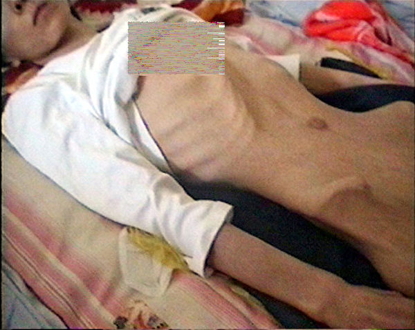 零零四年王霞被呼和浩特市女子監獄迫害得瘦骨嶙峋，奄奄一息。（圖片來源：明慧網）