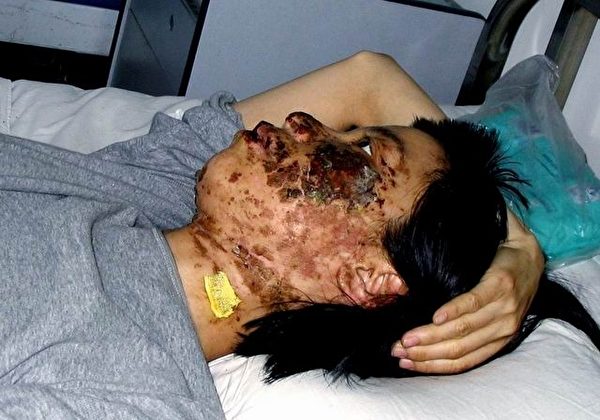 法輪功學員高蓉蓉2004年5月7日被酷刑折磨，臉上是電燒灼傷。照片是受傷10天後拍攝的