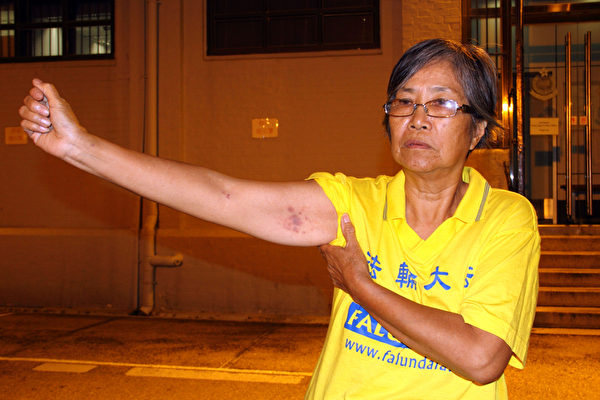 林妹珠遭警员强拉上车，手臂留下瘀痕。（摄影：潘在殊／大纪元）