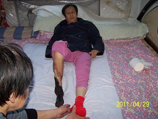 宋慧兰右腿变焦黑、溃烂、坏死，3个月不到整个右脚烂得已完全脱落，成终身残疾。（图片来源：明慧网）