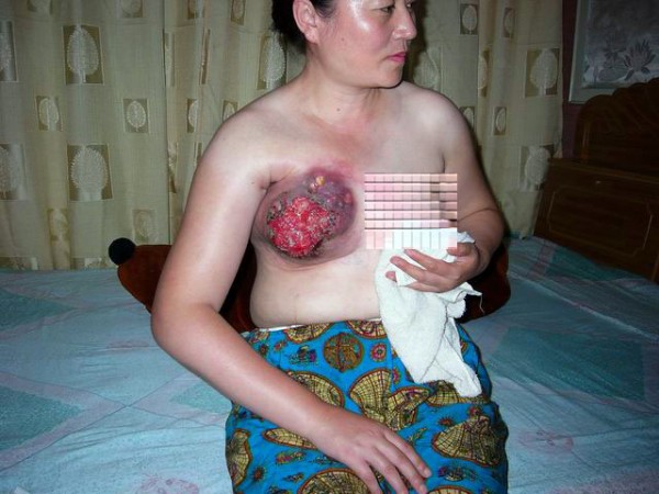 王雲潔被電棒電擊致使乳房潰爛（慎入）。（圖片來源：明慧網）