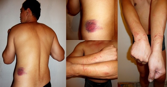 在警察抓人过程中造成的腰部伤痕（左图及中上图），手铐造成的伤痕（右图及中下图） 。                            