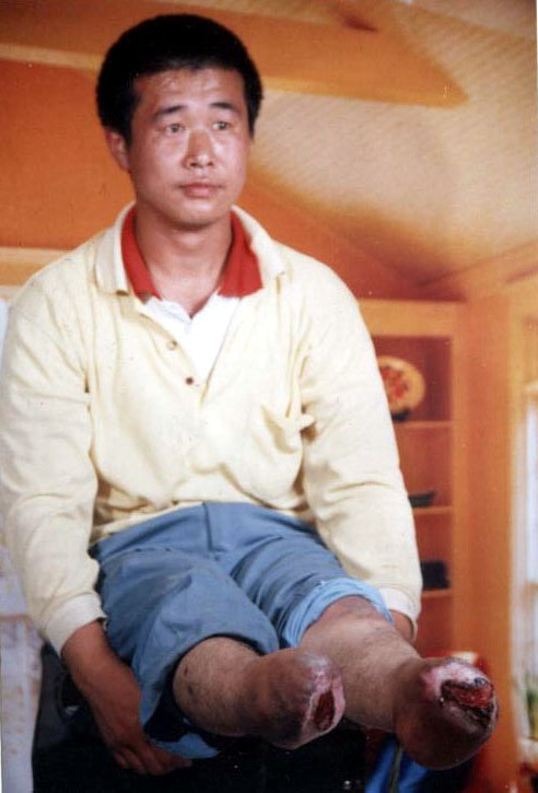 失去双脚的王新春，当时年仅26岁。（图片来源：明慧网）