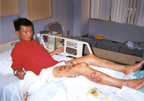 覃永潔被中國警察用燒紅的鐵條烙傷多處（明慧網）