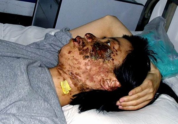 高蓉蓉2004年5月7日被酷刑折磨，臉上是電棍燒灼傷。照片是受傷10天後拍攝的。（明慧網）