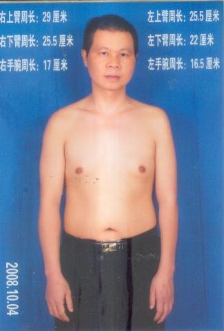 岳陽孫平華被酷刑折磨後，左臂肌肉萎縮。（明慧網）