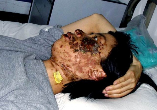 辽宁学员高蓉蓉遭狱警电击，面部严重毁容。（明慧网）
