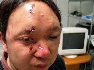 李淵博士2006年2月8日在家中遭持槍歹徒襲擊，臉上縫了15針。(大紀元)