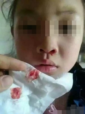 4月20日凌晨，江苏海安县城南实验学校再发生多名学生流鼻血、身体痕痒等症状，仅二年级就有逾半学生不适。（网络图片）