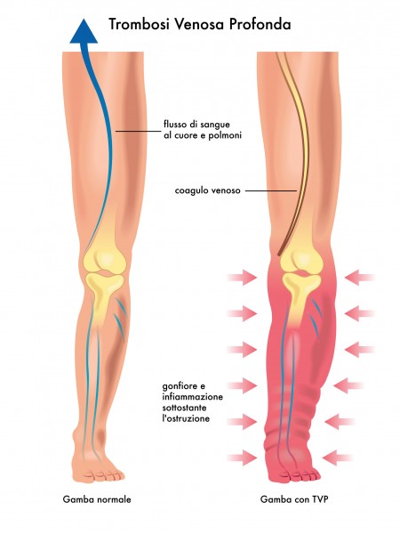 靜脈栓塞較常發生在下肢，又分為深部和表淺靜脈栓塞。（Fotolia）