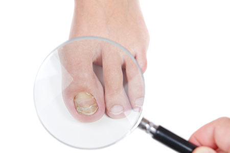 皮膚科醫生檢查的真菌，濕疹存在的指甲上。 （fotolia）