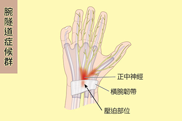腕隧道症候群就是通过腕隧道的正中神经因为受到压迫、压力变大等原因受损，使大拇指、食指、中指及无名指感到麻木的情况。（Shutterstock/大纪元制图）
